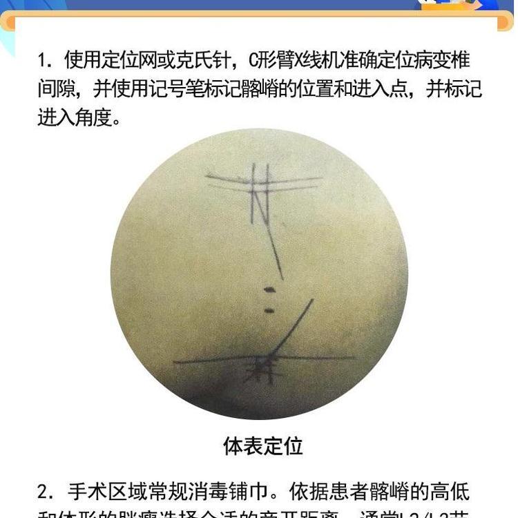 德國費格椎間孔內窺鏡ZKJ-1型進口脊柱單入路可視微創(chuàng)主鏡