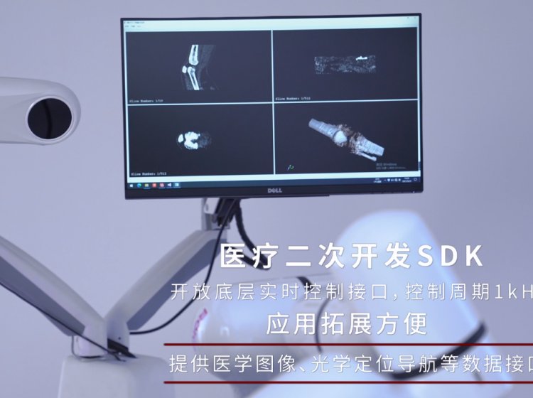 鐝炵煶xMate鍗�(xi茅)浣滄(j墨)鍣ㄤ汉绲�(ji茅)鍚堝厜瀛�(xu茅)瀹氫綅鍋氳啙楂栬笣鍏ㄩ棞(gu膩n)绡€(ji茅)缃彌姗�(j墨)鍣ㄤ汉