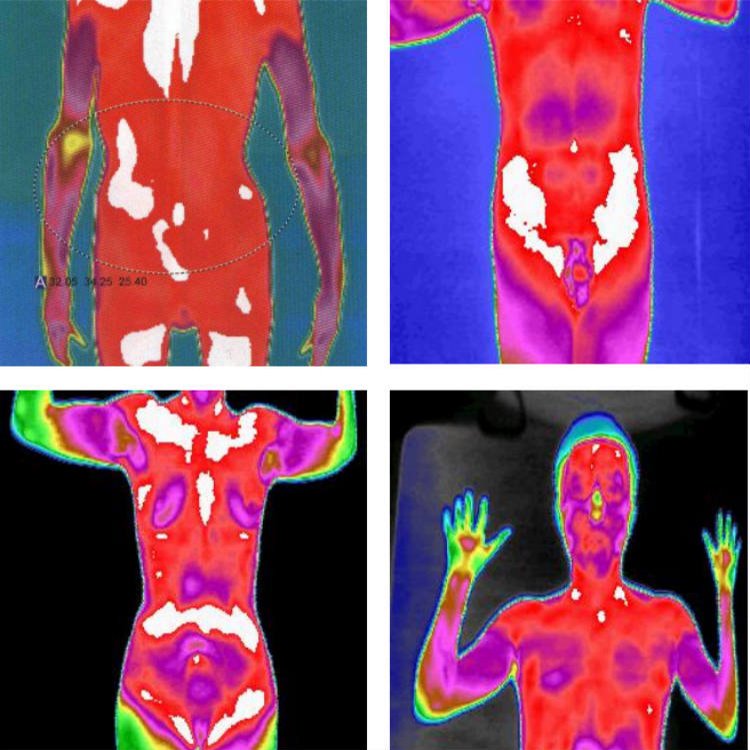 紅外成像檢測儀器醫(yī)用紅外熱像儀的功能中醫(yī)可視化影像檢測設(shè)備